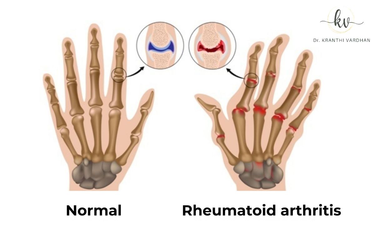 Ayurvedic Medicine for Rheumatoid Arthritis : fingers
