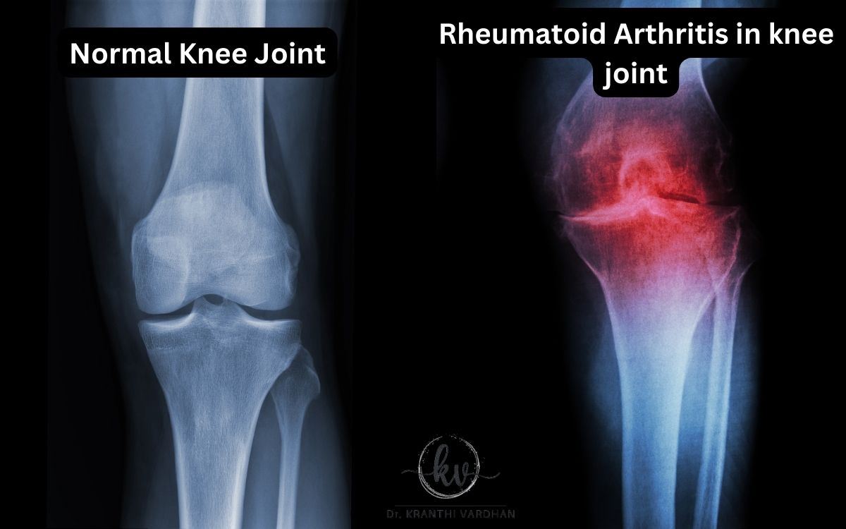 Ayurvedic Medicine for Rheumatoid Arthritis : knee