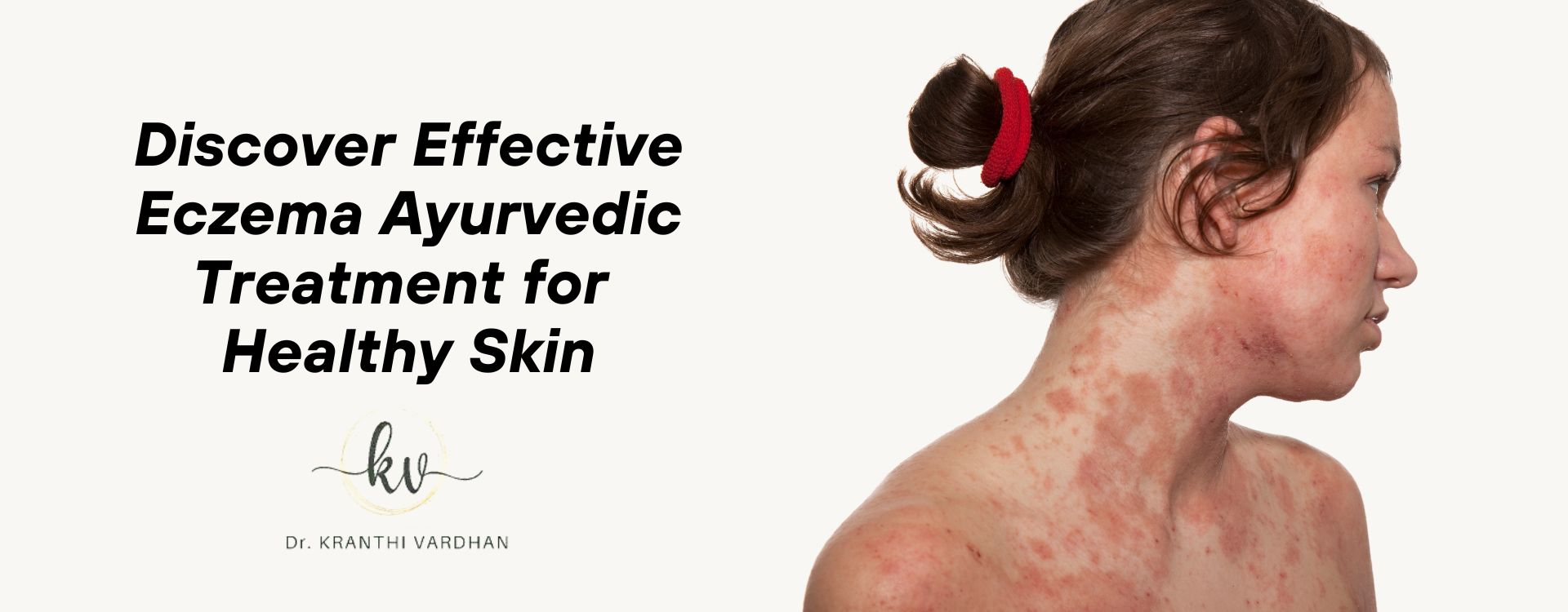 Discover Effective Eczema Ayurvedic Treatment for Healthy Skin