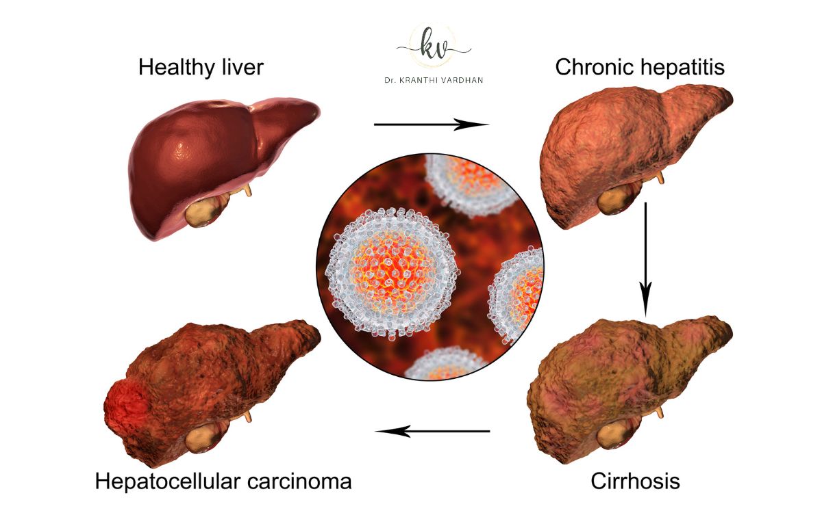 Fatty Liver Treatment in Ayurveda