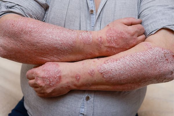 Psoriasis Treatment